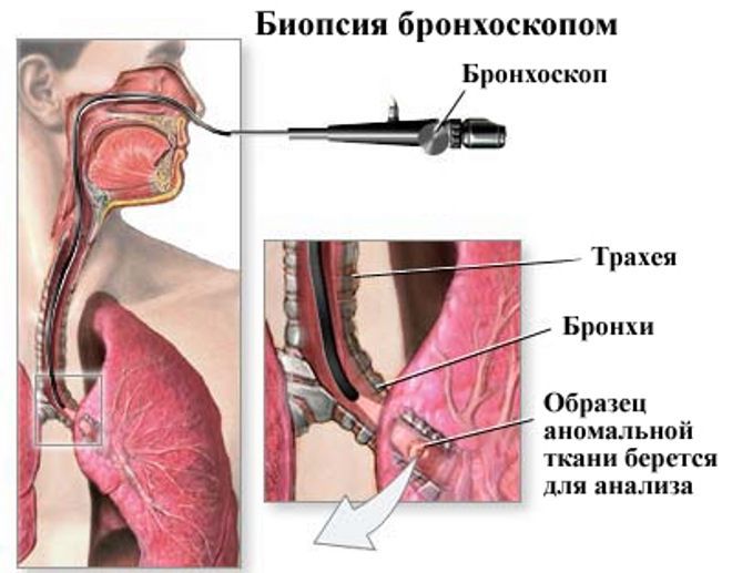 bronchoskopie s biopsií