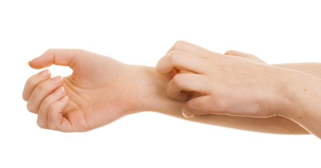Екзема върху ръцете - причини, симптоми и ефективно лечение на болестта