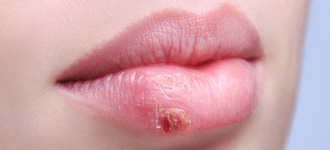 Херпес на лицето с симптоми на устните