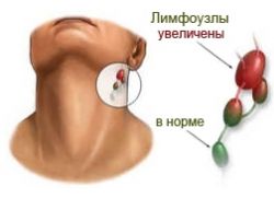 كيفية علاج العقد الليمفاوية