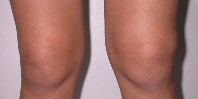 opuch nohy v oblasti kolena
