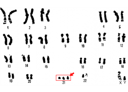 trisomy 21 فوق عتبة القطع