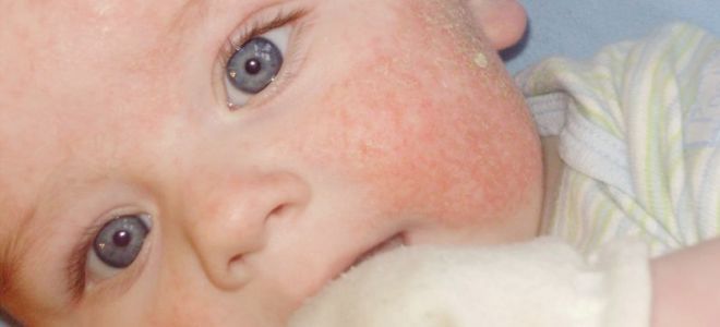 Alergická vyrážka u kojenců