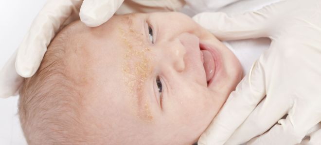 Alergická vyrážka u kojenců