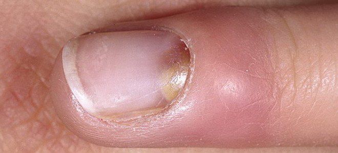 Staphylococcus na kůži rukou