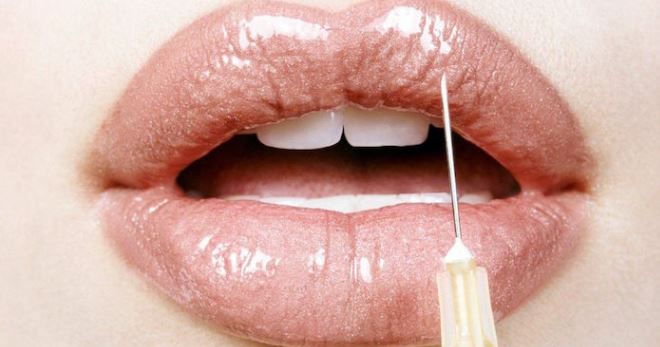 Увеличаване на устните с хиалуронова киселина - заслужава ли да се вземе решение за процедурата?