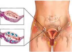 زيادة في المبيض في أسباب النساء