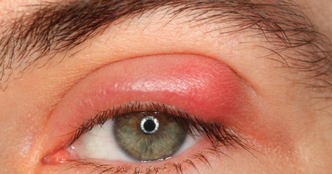 Ječmen na oko - co je nebezpečné, proč se vyskytuje a jak léčit gordeolum?